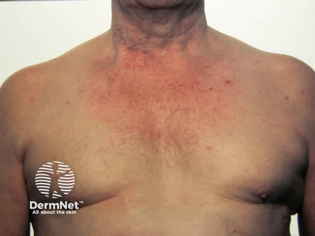 Clinical photography of the anterior chest and neck shows multiple erythematous, pinpoint lesions with radiating fine vessels consistent with spider naevi (spider angiomas). The lesions are small (approximately 1–3 mm), with a central red dot and a starburst pattern of telangiectatic capillaries that blanch on gentle compression. Distribution is predominantly on the upper chest and anterior neck, with some involvement of the shoulders. Surrounding skin is otherwise unremarkable, without edema or induration. This in vivo image demonstrates classic cutaneous telangiectasia arising from dilation of preexisting arterioles and capillary beds, producing the characteristic radiating vascular spokes. Spider naevi are benign vascular lesions commonly seen in young individuals but their multiplicity or new appearance in adults can indicate hormonal influences (estrogen excess) or underlying liver disease (cirrhosis, portal hypertension), pregnancy, or robust sun exposure in combination with vascular fragility. Clinically, identification should prompt correlation for systemic conditions, especially in patients with signs of liver dysfunction or heavy alcohol use. Differential diagnoses include cherry angioma, venous lake, capillary malformation, or telangiectasia related to hereditary hemorrhagic telangiectasia. This image is a useful educational reference for dermatology and internal medicine, illustrating recognition, documentation, and the clinical significance of vascular skin lesions in clinical practice today.