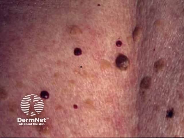 Imaging modality: clinical photograph of cutaneous surface. Anatomical context: integumentary system; skin with superficial dermal vascular lesions. The image depicts multiple cherry angiomas—tiny, bright red to purplish papules that are dome-shaped, well circumscribed, and compressible. Size ranges from a few millimeters to about 6 mm. The lesions blanch with pressure, consistent with superficial capillary proliferation. The surrounding skin shows a normal or mildly mottled background without ulceration or scaling. Distribution is scattered across the visible skin area, most prominent on the trunk and proximal limbs, a pattern typical of age-related angiomas. The lesions are non-toluid, with smooth surfaces and uniform coloration; no surrounding inflammation is evident. Pathophysiology involves dilated post-capillary venules in the dermis with minimal or no deeper tissue involvement. Clinically, cherry angiomas are benign vascular proliferations commonly seen in adults and the elderly; they usually do not ulcerate, itch, or bleed unless traumatized. The diagnostic significance is mainly reassurance; biopsy is rarely required. Differential considerations include other vascular lesions such as pyogenic granuloma, capillary hemangioma, spider angioma, and, in immunosuppressed patients, Kaposi sarcoma. This image supports dermatology education, primary care assessment, geriatric skin care, and visual diagnosis training.