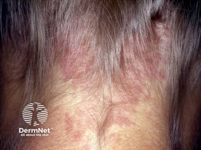 Imaging modality: Clinical photography of a cutaneous lesion. Subject is an adult with a patch on the posterior neck consistent with naevus simplex (salmon patch). The view is a close-up, posterior neck photograph intended to document color, borders, and surface characteristics. In this image the patch is flat and blanchable, range pink to light red, with an oval-to-irregular contour and well-defined margins. The surface appears smooth with no scale, crust, or induration; there is no nodularity or edema. The lesion resides within the integumentary system, involving the superficial dermis and dilated capillaries. Laterality is midline on the posterior neck. The patch is non-palpable and non-tender. This presentation aligns with classic sun-exposed naevi simplex findings in adults, a benign capillary malformation that commonly persists from infancy in some individuals. Diagnostic significance: benign, with no malignant potential; distinguishes from pigmented nevi only by vascular coloration and blanchability. Differential considerations include port-wine stain (nevus flammeus), small vascular malformations, and chronic inflammatory patches; clinical correlation and, if indicated, dermoscopy or vascular imaging can aid confirmation. Management is observational; treatment is typically unnecessary unless cosmetic concern arises or if lesion changes. Clinical education and documentation recommended.