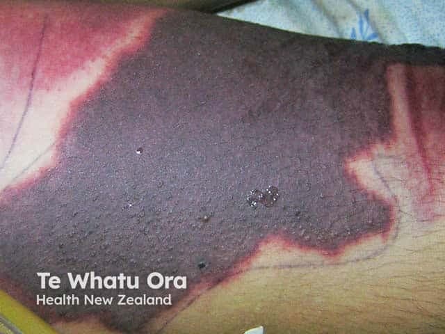 This is a clinical photograph illustrating extensive cutaneous involvement associated with disseminated intravascular coagulation (DIC). Imaging modality: Digital in vivo skin photography. Anatomical location: distal leg region with a large, nonblanching violaceous to dark purple patch showing irregular, geographic margins and a central necrotic area bordered by a pinkish-red rim. The lesion displays nonpalpable purpura with surrounding erythema and edema. Visual cues include mottled purple discoloration, ecchymosis-like zones, and tissue necrosis consistent with microvascular thrombosis and hemorrhage. Pathophysiology of DIC involves systemic activation of coagulation pathways with consumption coagulopathy and formation of dermal microthrombi leading to ischemic necrosis. This image provides a clinical correlate for severe coagulopathy in the setting of sepsis or hemorrhagic shock and aids differential diagnosis against purpura fulminans, meningococcemia, cutaneous vasculitis, necrotizing cellulitis, calciphylaxis, and stasis ulcers. Clinical significance includes urgent coagulation testing (PT, aPTT, platelet count, fibrinogen, D-dimer), blood cultures, sepsis evaluation, and immediate management: treating the underlying cause, hemodynamic support, and appropriate blood product transfusion with careful consideration of anticoagulation per protocol. Educational use: dermatology, hematology, emergency medicine, and pathology training in recognizing DIC cutaneous manifestations. Recognition of these lesions accelerates triage, sepsis workup, and multidisciplinary care.