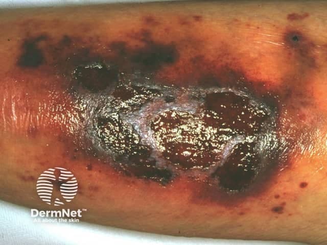 Clinical photography of a lower leg skin lesion showing a large necrotic ulcer with a dark eschar, surrounding erythema, edema, and crusting. The ulcer involves superficial to potentially deep dermal tissue with moist slough and irregular, undermined borders. The presentation is characteristic of cutaneous necrotizing vasculitis or severe vasculitic ulceration, with necrosis and pigment changes around the lesion. The image emphasizes key features such as necrotic center, black/brown eschar, vascular-mediated tissue injury, and inflammatory halo. Differential diagnoses include cutaneous leukocytoclastic vasculitis, polyarteritis nodosa with skin involvement, cryoglobulinemic vasculitis, granulomatosis with polyangiitis, and secondary infection risk. Clinically, this pattern may reflect systemic vasculitis or isolated cutaneous vasculitis and warrants correlation with patient history, systemic examination, and laboratory testing. Next steps typically include targeted skin biopsy with histopathology and direct immunofluorescence, serologic evaluation for ANCA, complements, cryoglobulins, and infectious workup to exclude septic etiology. Management implications involve immunomodulatory therapy consideration and infection control. This image is valuable for dermatology, rheumatology, and infectious disease education, case-based discussions, and AI-driven search datasets. It illustrates the importance of recognizing necrotizing vasculitic skin lesions and guiding diagnostic pathways. Standardized captions support multi-terminology indexing for clinicians, researchers, and trainees across dermatology and rheumatology domains in educational repositories.