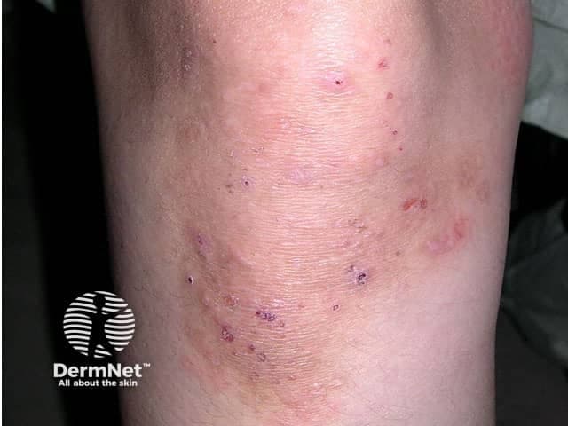 Imaging modality: Clinical photography, high-resolution close-up dermal photograph of the left/right elbow region captured with standard color balance to document cutaneous vesiculopapular eruption. Anatomical site: Antecubital fossa/extensor surface of the elbow, with overlying erythema and excoriations; similar lesions may appear on knees, buttocks, and back. Visual features: grouped vesicles and papules on an erythematous base, often coalescing into urticarial plaques; surrounding scaling and crusts; itching leads to scratch marks; lesions are intensely pruritic, arranged symmetrically on extensor surfaces, and may show crusted erosions. Pathology/diagnostic significance: While the image shows surface morphology compatible with dermatitis herpetiformis, definitive diagnosis relies on direct immunofluorescence demonstrating granular IgA deposition at dermal papillae, and histology showing subepidermal vesicles with neutrophils clustering at the dermal papillae. Clinically, dermatitis herpetiformis is strongly associated with celiac disease and gluten sensitivity; management includes dapsone for symptom control and a strict gluten-free diet. Differential considerations include linear IgA disease, bullous pemphigoid, and eczematous dermatitis. This image is useful for dermatology education, tele-dermatology triage, and comparative pathology during clinical examination and teaching archives; it supports recognition of extensor-predominant vesiculopapular itch, aids patient counseling, and guides biopsy or immunofluorescence testing. This image also supports clinical correlation, patient education, biopsy planning, and care.