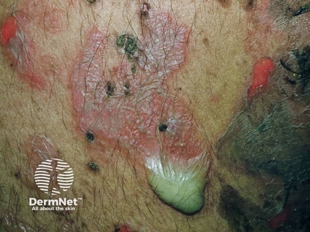 Pemphigus vulgaris, skin clinical photograph. This close‑up image shows erythematous, inflamed skin with ruptured and crusted erosions and several translucent, fragile blisters consistent with flaccid bullae; additional crusting and superficial crusted erosions are evident on the torso. The lesions are distributed across the chest and proximal trunk, with sparing or less involvement of surrounding intact skin. The photographic perspective emphasizes cutaneous involvement with preserved, yet damaged, epidermis and visible fragile vesicles. Clinically, pemphigus vulgaris is an autoimmune blistering disorder characterized by acantholysis and intraepidermal blister formation; the bullae rupture readily, producing painful erosions. The Nikolsky sign may be positive, indicating easy separation of epidermis with gentle pressure. For validation, histology would typically reveal suprabasal acantholysis with a tombstone row of basal keratinocytes; direct immunofluorescence shows intercellular IgG/C3 within the epidermis with desmoglein 3 and desmoglein 1 autoantibodies. Relevance to clinical practice includes prompt recognition for early systemic therapy to reduce progression and mucocutaneous involvement. Differential diagnoses include bullous pemphigoid and dermatitis herpetiformis. This image is relevant for dermatology education, autoimmune blistering disease research, and diagnostic dermato pathology correlation studies, serving as a reference for pattern recognition, disease staging, and treatment planning.