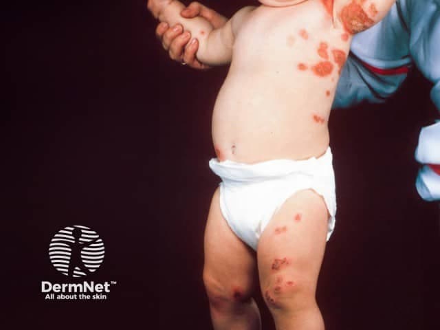 Clinical photography of a pediatric patient demonstrating bilateral axillary impetigo with kissing lesions. Imaging modality: dermatologic clinical photograph; technique: high-resolution color image under standardized frontal/anterolateral illumination; no staining or contrast employed. Anatomic focus: integumentary system, especially intertriginous axillary skin on both sides, extending to adjacent shoulder and upper chest. Visual features: multiple erythematous papules and vesicles with golden honey‑colored crusts along skin folds; some lesions show superficial crusting and erosions; bilateral symmetry with lesions meeting at the axillary creases, creating kissing lesions from close contact. The surrounding skin exhibits mild erythema and mild edema; distribution is intertriginous and continuous across bilateral axillae, with secondary spread to proximal medial arms. Pathology (clinical correlates): classic nonbullous impetigo caused by Staphylococcus aureus and/or Streptococcus pyogenes; contagious, transmissible in household contacts; result of minor trauma and moisture in skin folds. Diagnostic significance: recognition of kissing lesions in intertriginous areas supports impetigo diagnosis and informs antibiotic therapy and hygiene measures. Potential differential diagnoses include candidal intertrigo, contact dermatitis, eczema, varicella in atypical presentation, or fungal infection. Clinical use cases: educational dermatology imagery, triage reference for pediatric skin infections, infection control planning, and documentation of treatment response.