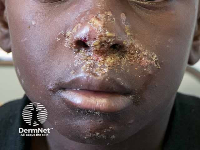 Imaging modality: Clinical photography (digital color image) of a pediatric patient's face in frontal view, focusing on the nasal and perioral regions. The image depicts honey-colored crusts and erosions centered around the nostrils and mouth with surrounding erythema and scaling, compatible with impetigo. Lesions appear superficial with crusted exudate, partial fissuring at the alar rim, and crusts coalescing into golden-brown plaques. The bilateral distribution is localized to the midface, with consented close-up representation suitable for dermatology assessment. The skin surface shows dry crusts, crusted erosions, and minimal edema; surrounding skin is mildly inflamed. The appearance is classic for non-bullous impetigo, most commonly caused by Staphylococcus aureus or Streptococcus pyogenes, though other organisms can contribute. The image helps distinguish impetigo from eczematous dermatitis, herpes simplex infection, or ecthyma by the characteristic honey crusts and focal periorificial involvement. Clinically, this finding is contagious and prompts antibiotic therapy and hygiene measures; topical agents such as mupirocin or fusidic acid may be used, with systemic antibiotics if extensive or bullous lesions are present. For education and research, this photograph serves as a reference for pattern recognition, differential diagnosis, and treatment planning in pediatric dermatology.