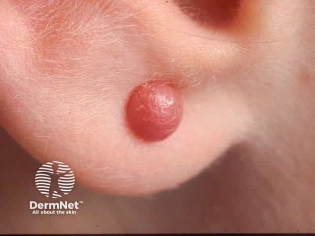 Imaging modality: Clinical photography; high-quality close-up macro view of the earlobe documenting a solitary keloid scar at a piercing site. Anatomical location: auricular lobule, periauricular skin, left or unspecified ear. Visual features: a firm, rounded, dome-shaped nodule with smooth, pink-red surface; surrounding skin shows mild dermal thickening without ulceration or purulent discharge; lesion is non-tender on palpation yet tethered within subcutaneous tissue by dense collagen; surface may appear shiny and slightly translucent. Pathophysiology: exuberant scar formation characterized by disorganized collagen deposition, scar tissue extending beyond original wound margins, with fibroblast proliferation and persistent inflammatory signaling; early matrix rich in type III collagen gradually replaced by type I fibers. Diagnostic relevance: classic piercing-related keloid; distinguishes from hypertrophic scar and granulomatous tissue; carries risk of recurrence after treatment if not adequately addressed. Clinical correlations: history of piercing trauma, possible itch or tenderness, cosmetic concern, psychological impact; imaging notes aid planning of therapy. Potential clinical applications: patient education, decision support for management strategies including intralesional corticosteroids, silicone therapy, laser ablation, cryotherapy, or surgical excision with adjuvant radiotherapy; monitor response and recurrence. Differential considerations: hypertrophic scar, epidermoid cyst, dermal granuloma, scar tissue. Clinical relevance: emphasizes cosmetic impact and informed, patient-centered management planning for outcomes.