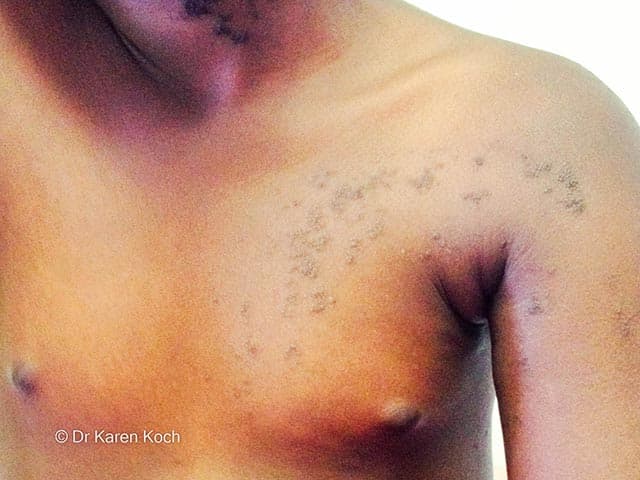 This is a high-resolution clinical photograph of a cutaneous epidermal nevus located along the left shoulder and anterior upper chest. Modality: clinical photography; technique: standard color image, with even lighting to depict surface texture and pigmentation; no dermoscopy or adjunct contrast used. The lesion demonstrates a classic Blaschko-linear distribution, a left-to-right, anterior-lateral cascade that follows embryologic skin cleavage lines. The primary subject is an epidermal nevus arising from keratinocyte proliferation within the epidermis, presenting as hyperpigmented, verrucous plaques that are well demarcated and mildly raised. In skin of colour, the pigment intensity may be accentuated, producing dark brown to black plaques with subtle scale and ridging; surface may be minimally hyperkeratotic. The pattern is typically unilateral and unilateral to the trunk and proximal limbs, with linear arrays aligning with Blaschko lines. Clinically, these lesions are generally benign but can be cosmetically disfiguring; differential considerations include inflammatory linear verrucous epidermal nevus (ILVEN), linear porokeratosis, and other pigmentary mosaicisms. Pathology, if pursued, would show acanthosis, hyperkeratosis, and mild papillomatosis without significant atypia. This image is useful for dermatology education, mosaicism concepts, and digital documentation in genodermatoses clinics. Helpful for patient counseling, telemedicine assessment, and research on Blaschko-linear cutaneous disorders in diverse populations.