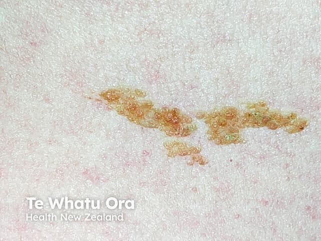 Clinical photography of a linear epidermal nevus. This image captures a single, elongated, hyperpigmented plaque with a slightly verrucous surface and mild keratotic scaling, arranged in a linear/serpiginous pattern along the skin. The lesion appears well circumscribed, non-inflammatory, and located on the cutaneous surface without obvious regional lymphadenopathy or ulceration. The distribution follows Blaschko's lines, a hallmark feature of epidermal nevi, indicating a mosaic somatic mutation in keratinocytes. The color ranges from light brown to tan with focal darker hyperpigmented conglomerates; surface texture is rough with papillomatous outgrowths at the margins. The image is a high-resolution clinical photograph (macroscopic close-up) without dermoscopic magnification or contrast enhancement. In suspected cases, histopathology would typically show hyperkeratosis, acanthosis, and slight papillomatosis with elongation of rete ridges, consistent with an epidermal nevus. Clinically, linear epidermal nevi are usually benign but can be associated with epidermal nevus syndrome if extensive or multisystemic. Differential considerations include inflammatory linear verrucous epidermal nevus (ILVEN), linear porokeratosis, and epidermal keratinocytic nevi of other distributions. The image is valuable for dermatology education, pattern recognition, genetic counseling discussion, and patient counseling about cosmetic management or laser/ablative therapy options. Proper documentation supports diagnosis, prognosis assessment, and multidisciplinary treatment planning for patient care.