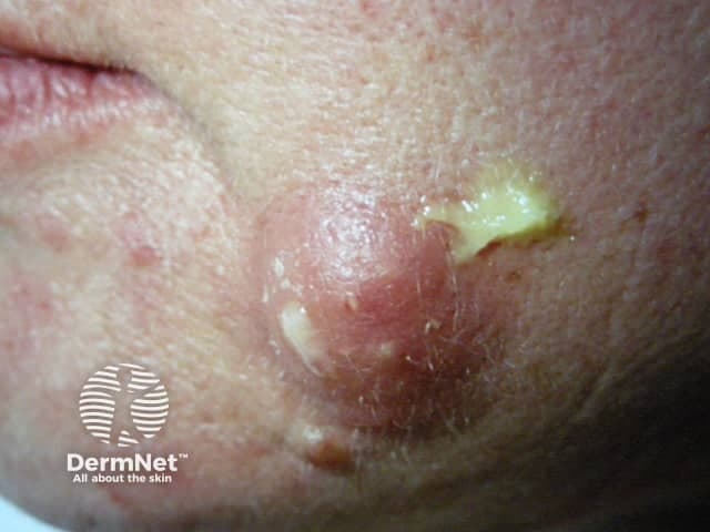 This is a high-resolution clinical photograph of a localized facial lesion on the left cheek/perioral region. Imaging modality: standard dermatology photography; viewpoint: anterior-lateral view. The lesion shows a red, erythematous plaque with a centered yellow crust, suggestive of a crusted exudate over an eroded surface. The surrounding skin is mildly inflamed with intermittent scaling. The crust appears honey-colored and adherent, characteristic of impetigo, a contagious superficial bacterial infection commonly caused by Staphylococcus aureus or Streptococcus pyogenes. Differential diagnoses include nonbullous impetigo vs bullous impetigo, bacterial folliculitis, contact dermatitis with secondary crusting, or eczema with secondary infection. No evident vesicles beyond the crust; no facial vesicular eruption is visible. If infection is present, treatment typically involves topical antibiotics (mupirocin, fusidic acid) or systemically if extensive, with emphasis on hygiene to prevent spread. The image emphasizes early recognition of impetiginous lesions on the face in adults and children. Clinically correlated signs such as fever, regional lymphadenopathy, or spreading redness would guide management. For radiographic correlation, consider bacterial culture in persistent cases or when confirming etiology. This photograph educates dermatology students on morphological features of crusted erythematous plaques. Note lesion color, crust density, and surrounding edema for assessment.