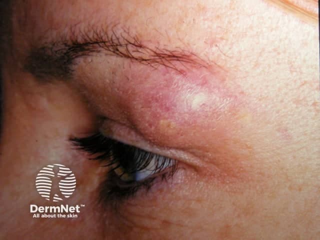 Imaging modality and technique: Clinical photography of the periorbital region, frontal close-up of the upper eyelid using diffuse illumination. Anatomical location: Upper eyelid (periorbital skin, lid margin). Visual features: a localized, dome-shaped erythematous nodule along the eyelid margin with mild surrounding edema and a possible central pustule, consistent with a stye (hordeolum) or blocked meibomian gland (chalazion) in early inflammation. Pathology and differential: The lesion reflects an inflammatory cyst-like lesion of eyelid glands; differential includes external hordeolum (stye), chalazion, sebaceous gland abscess, blepharitis, and preseptal cellulitis if spread occurs. Diagnostic significance: Distinguishes acute infectious eyelid inflammation from chronic eyelid granulomatous lesions; early recognition supports warm compress therapy, lid hygiene, topical antibiotics if indicated, and avoidance of squeezing. Clinical correlation: Correlate with symptoms such as tenderness, pain, eyelid swelling, fever, or discharge. Imaging context: Not applicable beyond clinical photography for dermatologic illustration. Utility: Educational reference for dermatology, ophthalmology, primary care; supports patient counseling, triage for antibiotic therapy, and monitoring for resolution or progression. Clinical outcome depends on timely management; signs of abscess formation, spreading cellulitis, or vision impairment require urgent evaluation. Documenting appearance aids clinicians in documenting severity, tracking response, and communicating prognosis to patients and trainees. Useful for teaching notes.