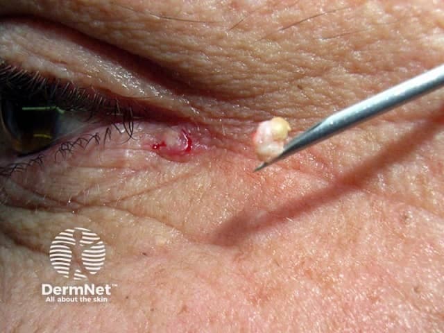 This is a high-resolution clinical photograph of a solitary epidermoid cyst on the periorbital skin (eyelid). Imaging modality: Clinical photography, macro close-up, captured during a minor incision. The focal area shows a small, skin-colored to slightly erythematous nodule with a superficial punctum. An incision with a sterile needle (green-handled device) has been made to evacuate the cyst contents. Exudate or keratinous material is partially expressed, appearing pale yellow to ivory and granular, consistent with laminated keratin debris typical of epidermoid inclusion cysts. The surrounding dermis shows minimal inflammation, with a small amount of blood at the incision margin. The cyst wall may be partially intact or collapsed, with the content partially expressed and not fully extruded in this frame. This image documents a common benign eyelid lesion managed with simple excision or drainage. In clinical practice, differential diagnoses include chalazion, milium, sebaceous cyst, or dermoid cyst; histopathology would reveal a stratified squamous epithelium-lined cyst containing lamellated keratin. Diagnostic significance lies in recognizing a benign, slow-growing eyelid mass that can be reduced by incision and expression, with definitive treatment via complete cyst excision to prevent recurrence. Clinical relevance spans ophthalmology, dermatology, and oculoplastic practices.