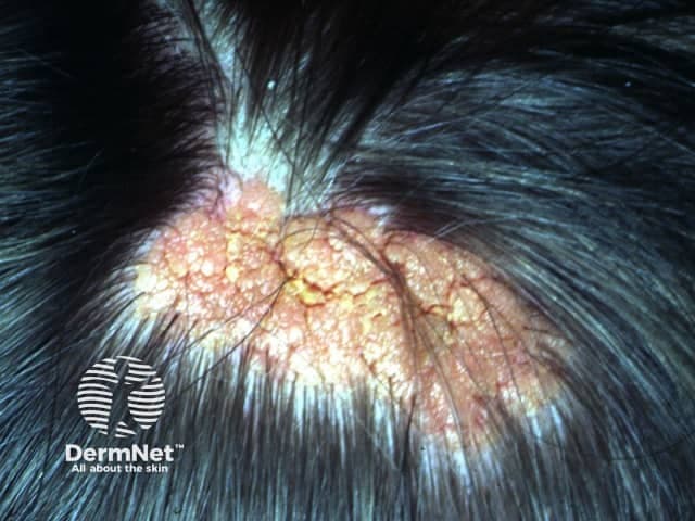 Sebaceous nevus on the scalp is a congenital cutaneous hamartoma characterized by an orange-yellow plaque with thickened, velvety surface and coarse, smooth to pebbly texture. In this close‑up clinical photography, the lesion is localized to the hair-bearing scalp, extending across several square centimeters. The overlying epidermis appears hyperkeratotic with a mosaic of pedunculated, papillomatous projections and mottled coloration ranging from pale yellow to tan to orange. Hair density around the lesion is variably reduced, and surrounding skin shows mild erythema consistent with chronic irritation. The lesion corresponds anatomically to ectopic sebaceous glands with diminished follicular development, commonly arising on the scalp, face, or neck. Histologically, nevus sebaceus features sebaceous gland hyperplasia with immature hair follicles and sebaceous differentiation embedded in a fibrous stroma. Clinically, this entity is part of the spectrum of adnexal hamartomas and is usually present at birth or early childhood, enlarging in early life and stabilizing thereafter. The significance lies in recognition of potential secondary neoplasms within nevus sebaceus, notably syringocystadenoma papilliferum or basal cell carcinoma, though malignant transformation is uncommon. Management often involves observation for changes or excision if cosmetically disfiguring or for risk of neoplasm, especially in adulthood. The image supports educational discussion of clinical appearance, differential diagnoses, and excision indications.