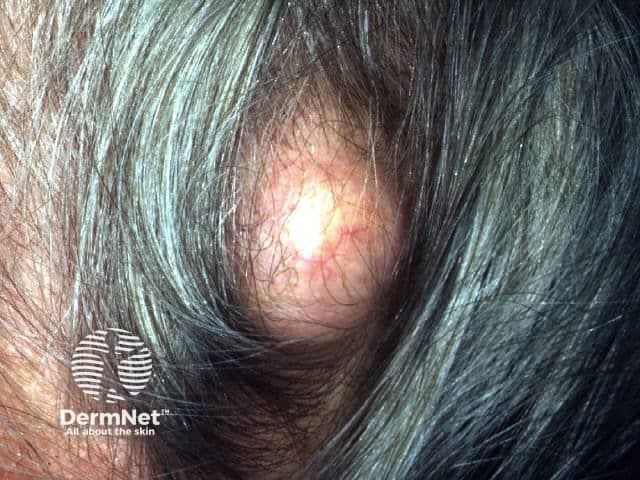 Imaging modality: Clinical photography (dermatology focus). Technique: High-resolution close-up macro photograph of a scalp lesion under diffused lighting. Location: Scalp within a hair-bearing region; the lesion is a solitary, well-circumscribed, dome-shaped nodule arising in the dermis/subcutaneous tissue. Visual features: skin-colored to mildly erythematous, smooth surface, firm consistency, non-tender, with no ulceration or surrounding edema; hair follicles lie overlying the lesion. Content: Keratinous material typical of pilar cysts; capsule appears well-defined. Pathophysiology: Pilar cysts (trichilemmal cysts) arise from hair follicle isthmus epithelium and show trichilemmal keratinization; on histology, absence of a granular layer and abrupt keratinization. Clinical significance: Benign adnexal skin cysts of the scalp that may recur after incomplete excision; differentiate from epidermoid cysts clinically and pathologically. Diagnostic use: Recognize as a benign lesion suitable for simple excision or conservative management; prognosis excellent after complete removal; longevity typically slow-growing. Potential clinical use cases: educational dermatology teaching, preoperative planning, patient counseling, differential diagnosis in scalp nodules, dermatopathology correlation. Imaging context: This image illustrates a benign scalp cyst with no invasion or ulceration. Management is usually simple excision; ultrasound, if used, shows a well-defined, avascular cyst with keratin debris and posterior enhancement. The lesion is typically mobile and subcutaneous beneath the hair.