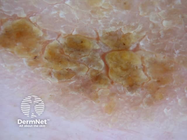 Clinical dermatology photograph illustrating multiple circular or oval plaques on pink, near-normal skin, each with a prominent golden-yellow crust consistent with impetigo. The image is a macroscopic skin photograph captured under diffuse ambient lighting with non-magnified view of the trunk or proximal limb region. Visual features include centrally eroded areas surrounded by a thick crust that appears amber to brown, with mild surrounding erythema and slight scaling. Lesions are clustered in a roughly linear or patchy distribution, lacking deep ulceration or purulent discharge. This presentation is typical of nonbullous impetigo, a superficial bacterial infection most often caused by Staphylococcus aureus or Streptococcus pyogenes; however, crusts may also form in secondary bacterial colonization of dermatitis. The image emphasizes a crusted, honey-colored exudate over nearly intact epidermis, consistent with surface infection, minimal necrosis, and a superficial dermal inflammatory response. Clinically, impetigo is highly contagious, commonly affects children, and may accompany mild pruritus. Differential diagnoses include crusted eczema, tinea corporis with secondary bacterial infection, and dermatitis herpetiformis in other contexts. Recognizing the yellow crust and peripheral erythema supports prompt initiation of topical antiseptics or antibiotics, and assessment for regional lymphadenopathy or systemic signs if dissemination occurs. This image is useful for educational comparison, dermatology atlases, and clinical training in infectious skin diseases.