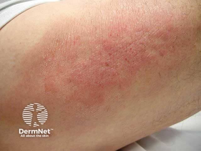 Clinical photograph of lichen simplex chronicus (neurodermatitis) on the upper arm, displaying red-brown, thickened plaques with conspicuous lichenification and accentuated skin markings. The lesion shows a rough, hyperkeratotic surface with underlying erythema, mild scaling, and scratching-induced excoriations. Chronic rubbing perpetuates the itch-scratch cycle, resulting in epidermal hyperplasia (acanthosis) and dermal inflammation, which may produce pigmentary alteration over time. Distribution is localized to a discrete upper-arm region, a common site for neurodermatitis due to habitual rubbing. The boundary is often ill-defined with variable borders, and the surrounding skin may be moderately dry. The image emphasizes hallmark features: durable plaque formation, pronounced skin folding, and a pattern consistent with localized chronic dermatitis rather than an acute eruption. Clinically, this appearance guides diagnosis toward lichen simplex chronicus and helps differentiate from psoriasis, tinea, or acute contact dermatitis. Management implications include potent topical corticosteroids, calcineurin inhibitors in sensitive areas, regular emollients, antihistamines for itch, and behavioral strategies to break the scratching cycle. The photo is valuable for dermatology education, teledermatology triage, and visual recognition of chronic itch-scratch dermatoses on the upper limb. This imaging scenario also supports patient education on chronic dermatitis, triggers identification, and adherence to treatment regimens.