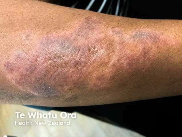 This is a high-resolution clinical photograph of a single, chronically irritated plaque on the forearm, captured with standard color dermatology photography under daylight illumination. The image depicts lichen simplex chronicus (neurodermatitis) manifesting as a well-demarcated, thickened, hyperpigmented plaque with prominent lichenification and fissuring at the surface. The lesion shows intensified skin markings, wrinkling, and a slightly violaceous hue around the periphery, reflecting chronic rubbing and scratching. The surrounding skin is mildly erythematous with subtle edema, consistent with ongoing pruritus and inflammatory response. From a dermatoscopic perspective, surface scales may be scant; however, tactile palpation would reveal firm, leathery consistency. Clinically, lichen simplex chronicus results from an itch-scratch cycle, producing epidermal hyperplasia (acanthosis), hyperkeratosis, and dermal papillary fibrosis. The image highlights typical features used to distinguish chronic eczematous dermatitis from acute flares, such as the thickened plaque, accentuated lines, and lack of acute exudation. Diagnostic significance lies in recognizing chronicity, guiding therapy with potent topical corticosteroids or calcineurin inhibitors, and addressing itch management, psychological triggers, and behavioral modification. Clinically relevant use cases include medical education, dermatology training, differential diagnosis exercises, and image-based documentation for patient records and tele-dermatology. This description supports accurate coding and reproducible educational content for teaching and research in dermatology training.