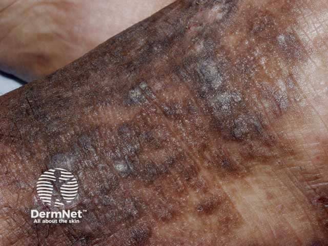 Clinical photography of a cutaneous plaque consistent with lichen simplex chronicus (neurodermatitis) affecting the dorsal hand/forearm. The image demonstrates hyperkeratotic, lichenified plaques with pronounced thickening of the epidermis and accentuated linear skin creases. The plaques are pigmented with variably brown to slate-gray hyperpigmentation and a scaly, rough surface. Dermal inflammation is suggested by peripherally hyperemic borders and faint erythema within the lesion. The distribution appears localized with well-defined margins, and there may be minor fissuring at pressure points. The appearance reflects chronic itch-scratch cycle leading to chronic scratching, which perpetuates the lichenification. The photograph provides a high-resolution, close-up view suitable for dermatology education and differential diagnosis. Notable differentials include atopic dermatitis, discoid (plaque) psoriasis, chronic contact dermatitis, and seborrheic dermatitis; however, the thickened, hyperpigmented plaques with accentuated creases and absence of classic psoriasis scale or orange staining favors lichen simplex chronicus. Clinically, this lesion would correlate with pruritus, focal scratching, and relief after rubbing; management considerations include topical corticosteroids, occlusion, antihistamines, and behavioral modification. This image is relevant for digital dermatology repositories, medical education, and phenotype documentation of neurodermatitis. Documentation should note lesion size, exact location, patient-reported itch intensity, nocturnal scratching, and response to therapy for longitudinal tracking and education.