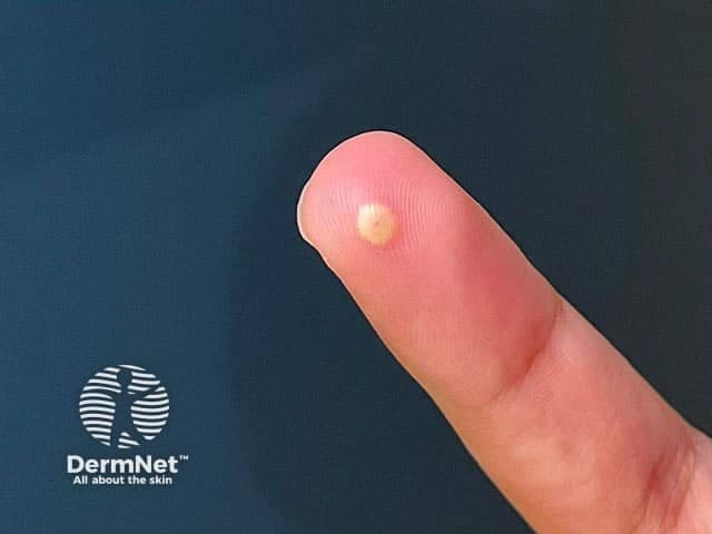 Dermnetnz