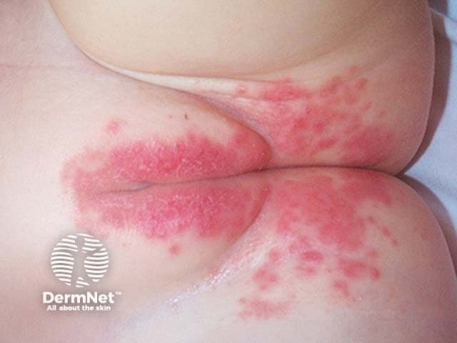 Clinical photography of the diaper area in a young infant showing napkin dermatitis (diaper dermatitis) with diffuse erythematous, moist plaques confined to the perineal, buttock, and inguinal regions within the diaper border. The rash is bilateral and symmetrical, with well-demarcated margins where diaper coverage ends, and a shiny, glazed appearance consistent with irritant contact dermatitis. Involvement extends to the inner thighs and intertriginous folds, without deep ulceration or necrosis. No discrete vesicles are evident, but papules and patchy confluent erythema are present. The surrounding skin may appear slightly desquamative in places, reflecting repetitive friction and moisture. The clinical picture favors irritant diaper dermatitis from prolonged exposure to urine and feces, minimized barrier protection, and occlusion by diapers. Secondary infection with Candida albicans is a consideration if satellite lesions or intensification of erythema occurs at flexural creases, though this image does not clearly show candidal features such as satellite pustules. Appropriate management includes frequent diaper changes, gentle cleansing, air exposure, and barrier creams containing zinc oxide or petrolatum; consider antifungal therapy if candidal involvement is suspected. This image is relevant for education on differential diagnosis with fungal diaper dermatitis, contact dermatitis to wipes, and pediatric dermatology case discussions.