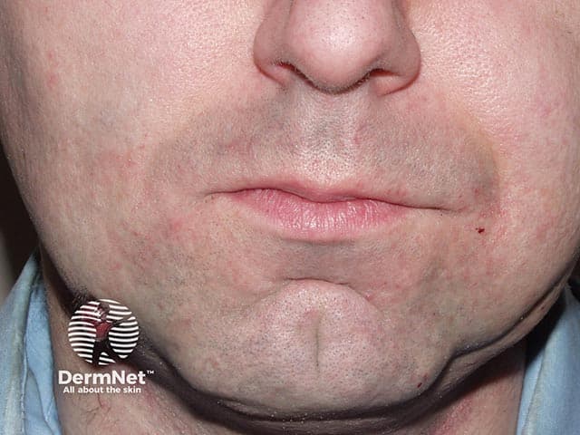 Imaging modality: Clinical photograph. This frontal view of the lower face documents a cutaneous lesion at the end of a dental sinus tract, i.e., an odontogenic cutaneous fistula terminating on the chin/perioral skin. The lesion is a small erythematous papule/nodule with a raised, smooth surface and subtle surrounding erythema. Minimal crust; no evident purulent drainage. Anatomically, it overlies the chin/lower face near the mandible with midline alignment; no atrophy or ulceration is evident. The photograph captures surface morphology without radiographic or histologic data, but the suggested diagnosis is a granulomatous response to a chronic dental infection, where a sinus tract drains via the skin. Clinically this finding indicates an odontogenic source rather than a primary dermatologic process. Pathologically, cutaneous granulomas associated with dental infection reflect granulomatous inflammation along the fistulous tract and may be accompanied by periapical inflammation of pulpal origin. Diagnostic significance lies in directing dental evaluation, radiographic imaging (panoramic/periapical), and source control through root canal therapy or extraction. Differential considerations include odontogenic cutaneous fistula, foreign body granuloma, and chronic dermatitis; clinical correlation with dental status is essential. Management typically requires multidisciplinary care integrating dentistry and dermatology to eradicate infection and close the sinus.