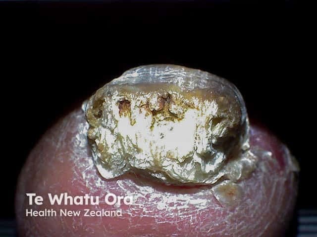 Clinical photography of the right hallux nail demonstrating total nail involvement (total onychomycosis) with marked subungual hyperkeratosis. The nail plate is thickened and opaque, with yellowish-brown crumbly debris filling the subungual space and lifting of the proximal edge. The proximal nail fold remains intact but overlies a markedly dystrophic nail bed. The surface of the nail shows irregular flaking and lamellar cracking consistent with chronic dermatophytic infection; the subungual keratotic mass is prominent. Imaging modality: Clinical photography; close-up, macro view; noninvasive. The anatomical location is the toenail unit, hallux, digit 1 of the foot. The observed features correspond to mycotic nail disease (onychomycosis) with hyperkeratosis, hypertrophy (onychosis), and subungual debris. Differential diagnosis includes psoriasis nail dystrophy, lichen planus, trauma-related nail dystrophy, and non-dermatophyte mold onychomycosis; however, the total involvement and characteristic subungual keratosis favor onychomycosis. Clinically, this finding is associated with prolonged fungal infection, potential discomfort, infection risk, and functional impairment; it may respond to systemic or topical antifungal therapy and debridement. This image is relevant for dermatology education, clinical diagnosis practice, and image-based medical training; useful for AI datasets focusing on nail pathology, fungal infections, and subungual hyperkeratosis. This image aids lesion recognition, grading severity, and treatment planning decisions.
