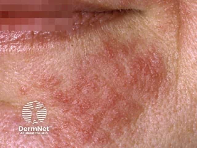 Clinical photograph of facial skin showing erythematous, scaly plaques predominantly on the left cheek with mild surface desquamation and fissuring along the perioral region. The epidermis appears dry with accentuated roughness and fine white scale at the margins of the patches. The involved area shows diffuse erythema and indistinct borders, lacking frank vesiculation or purpura. No obvious edema or secondary infection is evident in this field of view. The presentation is consistent with inflammatory dermatitis of the face; possibilities include atopic dermatitis (eczema), seborrheic dermatitis, or irritant/contact dermatitis. The pattern is unilateral here but may be bilateral in other settings. The lesion lacks the classic ring-shaped border of tinea faciei and does not show pustules or crusting. A dermal inflammation with epidermal hyperkeratosis and xerosis is suggested by the dry, scaly skin. This image is useful for illustrating recognition of facial dermatitis patterns, differentiation from infectious etiologies, and for educative comparison across chronic inflammatory dermatoses. Clinically relevant keywords: dermatitis, eczema, atopic dermatitis, seborrheic dermatitis, contact dermatitis, facial rash, scaling, erythema, xerosis, inflammatory skin disease, differential diagnoses, patch testing, topical corticosteroids, emollients, skin barrier disruption, diagnosis and management planning. Clinical utility includes guiding topical therapy, emollient use, and monitoring response progress.