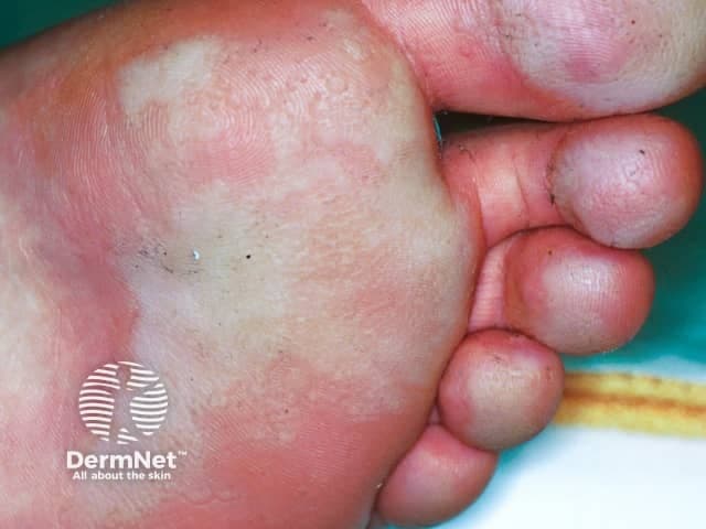 Clinical photograph of the plantar surface of the foot demonstrating classic pitted keratolysis. The image captures white, macerated, moist keratoderma with shallow, punched-out pits distributed across the weight-bearing sole, most prominently in the central metatarsal area. The surrounding skin shows mild erythema and desquamation; there is minimal scale at the periphery. This condition results from superficial bacterial decomposition of keratin in occluded, sweaty skin, commonly Corynebacterium species, and is favored by warm, moist environments and occlusive footwear. The pits appear as small depressions that may drain or secrete moisture; the lesion lacks true vesicles, purulence, or significant inflammatory infiltration. Clinically, pitted keratolysis is differentiated from tinea pedis by its characteristic pits rather than annular scaling; interdigital involvement is common; interdigital maceration may be present. Diagnostic significance lies in recognizing moisture-associated superficial infection, which responds to improved drying, antiseptic washes, and topical antibiotics. Potential clinical use cases include diagnostic aid in dermatology education, teledermatology triage, and differential diagnosis for plantar pits and maceration. This image provides educational reference to correlate appearance with microbiologic etiology and to guide management, including hygiene modification, barrier protection, and targeted topical therapy. These features reinforce a moisture-based bacterial etiology.