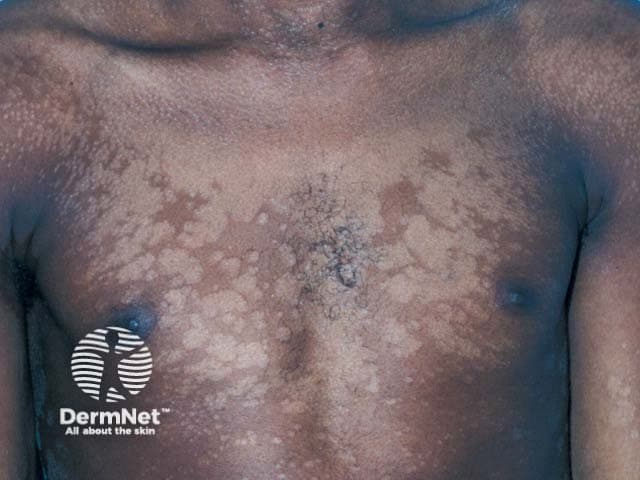 Comprehensive description: This is a high-resolution clinical photograph of the trunk depicting pityriasis versicolor–related hypopigmented patches. Imaging modality: Clinical photography of the anterior torso using standard lighting, color calibration, and digital capture to document surface pigmentary changes. Anatomical localization: Trunk (anterior chest and upper abdomen) within the integumentary system, illustrating cutaneous involvement of the thoracic skin. Visual features: irregular, coalescent hypopigmented macules and patches with fine superficial scale; color contrast against surrounding darker skin; scalloped margins with some central clearing and patchy confluent areas; distribution is predominantly on the chest, extending laterally and toward the upper abdomen. Pathology/disease: Classic presentation of pityriasis versicolor from Malassezia species causing superficial pigmentary disturbance without deep tissue invasion. Diagnostic significance: Supports clinical diagnosis of tinea versicolor; findings are often complemented by Wood’s lamp fluorescence (copper-orange) and potassium hydroxide examination revealing yeast and hyphae; antifungal therapy yields pigment restoration. Clinical use cases: Dermatology education, documentation of pigmentary disorders, monitoring response to topical or systemic therapy, and research into Malassezia-related hypopigmentation. This description emphasizes terminology such as pityriasis versicolor, tinea versicolor, hypopigmented macules, trunk, anterior view, Malassezia pigmentary change, and antifungal management. The image serves as a teaching and archival reference for pigmentary dermatoses in clinics.