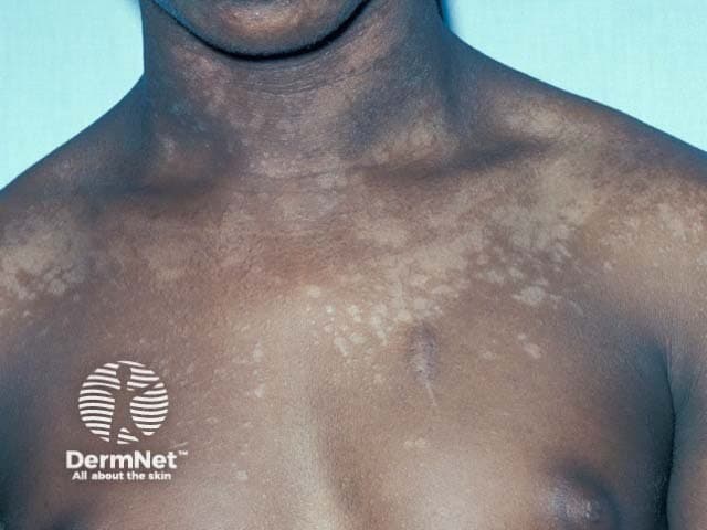 Clinical photography of the upper trunk demonstrates depigmented macules and patches consistent with pityriasis versicolor (tinea versicolor). Modality: Clinical photograph; view: anterior chest and proximal shoulders, with the neck and clavicular regions visible for orientation. The lesions are multiple, irregularly shaped hypopigmented macules with faint, fine scaling on the surface. Pigment loss ranges from light tan to coppery-tinged depigmentation against the patient’s darker baseline skin tone. The distribution is predominantly on the upper trunk and anterior shoulders, with relative sparing of central chest regions; lesion margins are ill-defined and patches may coalesce to form larger mosaic areas. The surface is typically non-tender and non-erythematous, with mild scale that can be accentuated by scraping. Although a clinical diagnosis is often sufficient, Wood lamp examination may reveal copper-orange fluorescence consistent with Malassezia species. The image is valuable for dermatology education and for identifying common confounders such as vitiligo or pityriasis alba. Pathophysiology involves superficial fungal colonization of keratinocytes with pigment disturbance. Clinical significance includes cosmetic concern and potential recurrence; antifungal therapy (topical azoles or selenium sulfide) usually yields improvement. This depiction supports differential diagnosis, clinical correlation, and imaging-augmented teaching in dermatologic curricula, tele-dermatology consultations, and patient counseling.