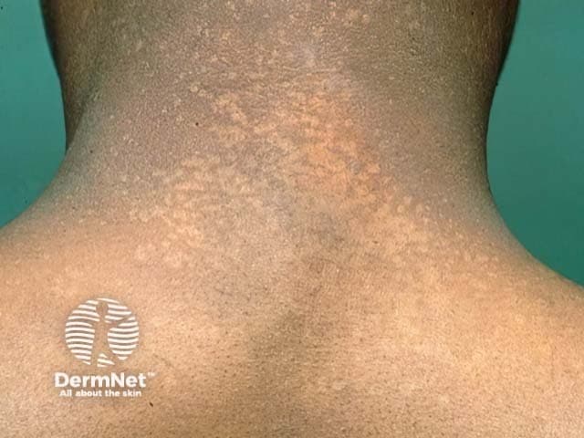 Imaging modality: Clinical photography of the neck using standard visible light. View: posterior neck/dorsal neck. Primary subject: pityriasis versicolor (tinea versicolor) affecting the nuchal region. The image shows multiple oval to irregular hypo- to hyperpigmented macules and patches with fine, barely perceptible scale distributed across the posterior cervical area. The lesions are superficial in the stratum corneum with slight erythema in some patches; edges are ill-defined. Pigment changes range from tan-brown to pale, producing a mottled appearance on sun-exposed skin. The overall pattern is localized to the nape, consistent with pityriasis versicolor. Pathophysiology involves Malassezia species causing lipid-dependent yeast/hyphae growth in the stratum corneum; fluoresces copper-orange under Wood's lamp; potassium hydroxide smear yields 'spaghetti and meatballs' pattern. Clinically, this entity is important to differentiate from vitiligo, eczema, dermatophyte infections, and post-inflammatory hypopigmentation; differential diagnoses include tinea versicolor, hypopigmented mycoses, and contact dermatitis. Diagnostic significance: characteristic distribution with scaling and color variation, supportive findings from Wood's lamp and microscopy. Management often involves topical antifungals (selenium sulfide, azoles such as ketoconazole or fluconazole systemically for extensive disease) and maintenance therapy to prevent recurrence. Use cases: dermatology clinics, medical education, lesion localization teaching, image databases for skin infections, AI dermatology research.