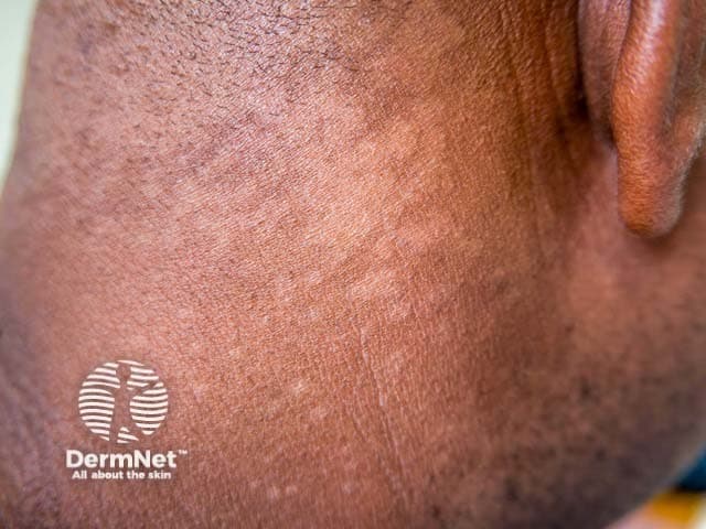 This dermatology-focused clinical photograph documents a lateral view of the neck showing hypopigmented macules and patches consistent with pityriasis versicolor (tinea versicolor). Imaging modality: clinical photography; technique: standard color capture under even, diffuse lighting with minimal skin compression to preserve pigment and texture. Anatomic location: integumentary system, cervical region of the neck, involving the superficial epidermis and dermis. Lesions appear as flat, hypopigmented patches with mild scaling and slightly irregular margins; the surface is otherwise smooth and non-erythematous. The lesions are primarily lighter than surrounding skin and may tan variably with sun exposure; edges often blend with adjacent skin. Pathophysiology: Malassezia species colonization leads to lipid degradation and pigmentary alteration, producing hypo- or hyperpigmented macules that fluoresce under Wood lamp in some cases. Differential considerations include vitiligo, post-inflammatory hypopigmentation, and pityriasis alba. Clinical significance: the pattern of neck involvement with fine scaling and non-inflammatory appearance supports a tinea versicolor diagnosis and guides antifungal therapy. Potential clinical use: educational dermatology reference, telemedicine triage, documentation of treatment response to topical azoles or systemic antifungals, and monitoring for recurrence. Wood lamp examination may reveal yellow-green fluorescence in active lesions, and a potassium hydroxide (KOH) preparation can help confirm Malassezia species involvement when available.