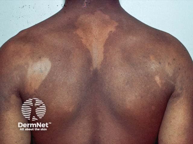 Clinical photography of the back showing large hypopigmented patches consistent with pityriasis versicolor (tinea versicolor). The dorsal trunk demonstrates irregular, well-demarcated macules with reduced pigment relative to surrounding skin and slight surface scaling. Lesions are primarily on the upper back and shoulders, sometimes extending centrally, with a predominantly hypo pigmented appearance in darker skin tones and mixed hypo/hyperpigmentation in lighter tones. The patches may appear less conspicuous in sun-exposed areas and more noticeable in cooler seasons. On close inspection, there is minimal erythema or itching; scale, when present, is fine and compelling under dermoscopy or magnification. The imaging modality is clinical photography, without contrast, intended for documentation and educational reference. The pattern is truncal, symmetric or patchy, often affecting the upper back, shoulders and central chest in typical presentations. In practice, differential diagnoses include pityriasis alba, post-inflammatory hypopigmentation, chronic eczema variants, and hypopigmented tinea corporis. Clinically, pityriasis versicolor is caused by Malassezia species; diagnosis is supported by KOH showing spaghetti-and-meatballs and Wood's lamp fluorescence. Management involves topical azoles or oral antifungals in extensive disease. This image supports dermatology training, telemedicine consultations, and research into pigmentary disorders, fungal colonization, and treatment response. It serves as a reference for pattern recognition globally.