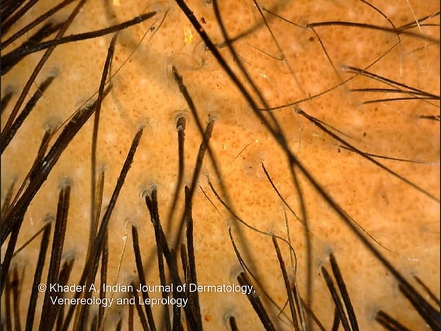 Trichoscopic (scalp dermoscopy) image of a PLACK syndrome patient presents close-up visualization of scalp hair and surrounding epidermis during noninvasive examination. The study field shows a beige-orange scalp background with multiple dark hair shafts projecting over the surface, oriented obliquely and overlying miniature follicles. This pattern is characteristic of alopecia areata in which non-scarring hair loss occurs; dermoscopic features commonly described for alopecia areata include yellow dots representing keratin within follicular infundibula, exclamation-mark hairs indicating fragility, black dots corresponding to follicular ruptures, and short broken or regrowing vellus hairs. In this image, the dense distribution of terminal hair shafts and the relatively intact epidermis suggest an early or patchy alopecia is occurring rather than a scarring process. The presence of many hair shafts crossing at various angles across a sparse follicular opening may reflect ongoing follicular activity with shedding and re-growth; such patterns are useful for longitudinal assessment and therapeutic response. In the clinical context of PLACK syndrome, alopecia areata patterns observed on trichoscopy can aid differential diagnosis from other etiologies such as traction alopecia, tinea capitis, and androgenetic-type hair loss. Overall, this trichoscopic snapshot provides rapid, noninvasive confirmation of alopecia areata involvement in PLACK syndrome. Correlative clinical assessment is recommended.