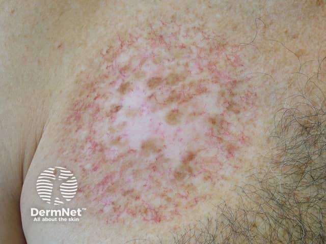 Clinical photograph of a skin lesion on the left shoulder/upper chest region displaying an annular, erythematous plaque with central clearing and fine desquamation. The lesion shows a pink-red, slightly raised border and irregular, patchy hypopigmentation in the center. Surrounding skin is mildly erythematous, with peripheral scale and no obvious vesiculation. The pattern resembles a ring-shaped dermatitis consistent with tinea corporis (dermatophyte infection) or an annular plaque with an active border. Differential diagnoses include tinea corporis, granuloma annulare, discoid eczema, plaque psoriasis with annular configuration, and contact dermatitis. The lesion appears well-demarcated with expansion margins and central clearing; the border may be scaly and demonstrates variable pigmentation. Notable features: peripheral pruritic erythema, annular geometry, scaly edge, central clearing, and mild crusting. Clinical significance: ring-like lesions on trunk or proximal limbs warrant superficial fungal evaluation (KOH preparation) and fungal culture, particularly in individuals without immunosuppression. Management implications include topical antifungals (terbinafine, azoles) and escalation to systemic therapy if widespread or unresponsive. This image is suitable for dermatology education, teledermatology triage, and differential diagnostic training focusing on annular erythematous plaques. Keywords for indexing: annular lesion, dermatophyte infection, ringworm, border scaling, central clearing, papulosquamous, inflammatory dermatology, infection vs. inflammation, imaging modality: clinical photo reference.