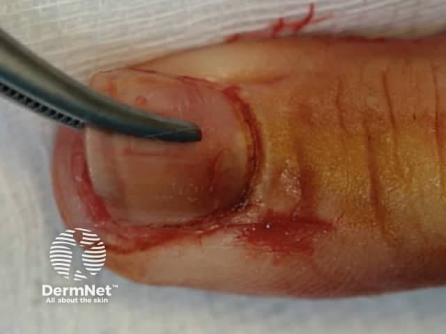This high-resolution clinical photograph captures a close-up view of the distal finger tip focusing on the nail unit and surrounding paronychia region. The image appears to show a postoperative or laceration site along the lateral nail fold with a curvilinear incision, likely from a nail bed repair or paronychia procedure. The nail plate is partially or fully in place, with the surrounding periungual skin reddened and mildly edematous. Blood-tinged tissue and minor superficial bleeding are present at the incision margins, consistent with recent surgical manipulation or acute injury. A pair of surgical graspers can be seen near the wound, indicating active tissue handling. The skin texture shows intact epidermis with subtle desquamation; no exposed bone or deep necrosis is evident. Lighting is bright and diffuse, highlighting the pinkish-tan skin tone and vascular pattern. This image demonstrates common postoperative fingertip wound appearance, periungual skin involvement, and nail-fold anatomy, including the nail plate, surrounding cuticle, and lateral gutter. Clinical relevance includes evaluation of wound edges, signs of infection, alignment of the nail bed, and healing trajectory; used for dermatology, hand surgery, and medical education to teach nail unit injuries, wound care, suture technique, and postoperative monitoring.