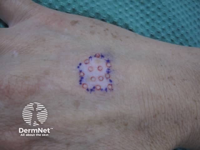 Clinical photography of vitiligo surgical planning on the dorsal hand. The area is demarcated with a round recipient-site grid drawn in blue ink; within the circle, small circular recipient holes are distributed in a uniform lattice. Red circular marks inside indicate planned grafts or donor sites. The surrounding skin shows depigmented patches characteristic of vitiligo with sharp borders and even texture in adjacent normal skin. The markings provide a standardized template for punch grafting or epidermal cell transplantation to achieve repigmentation by repopulating epidermis with melanocytes. The technique is used for stable, localized vitiligo and aims to establish contiguous pigment across the affected patch via transplanted melanocytes from pigmented donor skin. The image documents preoperative planning or intraoperative marking. It highlights key steps in vitiligo surgery: selecting a favorable recipient area, ensuring adequate coverage density, maintaining graft orientation, and minimizing graft rejection or failure. Clinically, this photo is suitable for dermatology, dermatologic surgery, and plastic surgery education, as well as research on graft take, repigmentation rates, and end-point outcomes. It also illustrates the importance of patient counseling regarding procedure duration, downtime, and expected cosmetic results. Documentation of instrument handling and markings can aid reproducibility across centers.