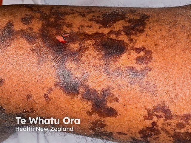 Clinical photography of an affected extremity demonstrates incipient skin necrosis in the setting of purpura fulminans. The image shows mottled, retiform purpuric patches with dark brown to black centralized necrosis against a background of erythematous to coppery skin. Lesions are irregular in shape, coalescing in some areas, with peripheral hemorrhagic crust formation emerging at the lesion margins. The distribution is patchy across the distal leg, consistent with cutaneous microvascular occlusion and ischemic injury. This appearance reflects progression from palpable purpura to early necrosis associated with disseminated intravascular coagulation (DIC) and severe sepsis in PF. Key visual cues include confluent retiform patterning, non-blanching discoloration, and evolving tissue necrosis that risks desquamation and potential gangrene if untreated. The photograph, obtained under standard ambient lighting without dermatoscopic magnification, provides rapid bedside documentation of skin viability and guides urgent clinical decisions such as escalation of antimicrobial therapy, hemodynamic support, and surgical consultation for potential debridement or amputation planning if progression occurs. The image is useful for education on PF cutaneous manifestations, differentiation from leukocytoclastic vasculitis, and radiologic or laboratory correlation in suspected septic DIC. It supports differential diagnoses of vascular occlusive pityriasis vs infection-related necrosis and underscores the urgency of prompt intervention. Urgent multidisciplinary care is essential.