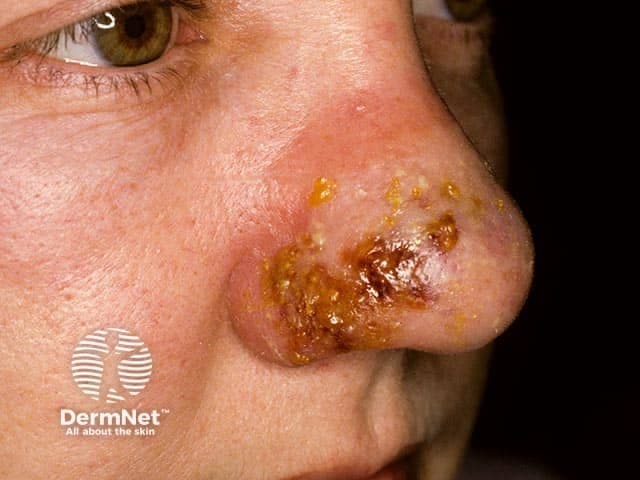 Clinical photography of the external nose shows unilateral cellulitis with thick, adherent crusts and yellow-brown exudate on the nasal dorsum and ala. The image captures erythematous, swollen skin with crusted lesions and surrounding desquamation. Modality is close-up color photography without contrast, suitable for documenting cutaneous infection and supporting differential diagnoses such as impetigo, erysipelas, and nasal cellulitis. The clinical impression references PVL-producing Staphylococcus aureus with potential necrotizing features; PVL infections are notable for rapid progression and tissue destruction, underscoring the need for culture-directed therapy and infection-control measures. This image is relevant for medical education, dermatology and infectious disease research on PVL staph infections, and case-based learning in clinical rounds. Relevance extends to wound care planning, antibiotic stewardship, and monitoring for progression to abscess or deeper facial space involvement. Overall, the photo emphasizes external nasal involvement, crusting, edema, and the importance of prompt clinical assessment and targeted management in suspected PVL-associated skin infections.
