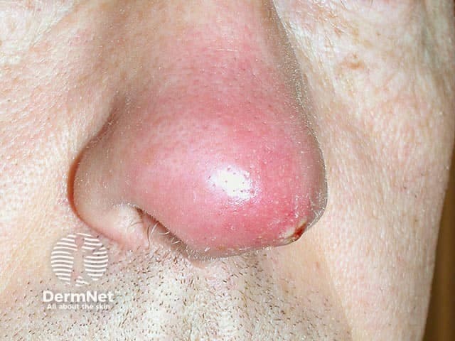 Clinical photography of a single nasal skin lesion showing an acute furuncle (boil) on the nasal vestibule/dorsum. The image depicts a solitary, erythematous, dome-shaped nodule with a shiny surface and surrounding mild edema. A palpable tenderness is suggested by the lesion’s conspicuous inflamed halo. A central pustule or crust may be present at the core, consistent with progression toward abscess formation within a pilosebaceous follicle. The lesion is located on the external nasal skin near the nostril, with frontal/anterior perspective offering clear visualization of the nasal bridge region. The clinical diagnosis is furunculosis of the nose, most often caused by Staphylococcus aureus; in this case PVL (Panton-Valentine leukocidin)–producing strains are implicated, which are associated with more aggressive skin and soft tissue infections and a higher risk of complications. Imaging is not radiologic; this is a dermatologic/clinical photograph used for documentation, teaching, and correlating with microbiology culture results. Management implications include incision and drainage if fluctuant, culture to guide antibiotics, and consideration of toxin-producing strains. The image serves educational purposes for dermatology, infectious disease, microbiology, and medical training in recognizing PVL-associated nasal furunculosis and differentiating it from impetigo, cellulitis, and Sty.