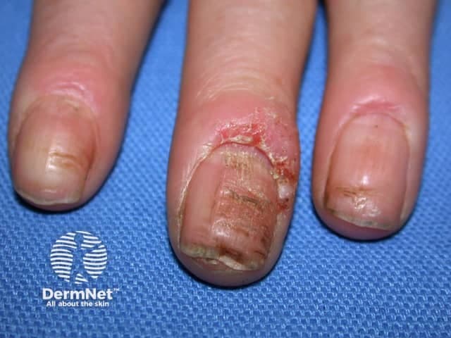 Clinical photography of the periungual digits demonstrating acute paronychia with inflamed, erythematous nail folds. The central and ring fingers show pronounced edema surrounding the proximal nail folds, with fissuring of the cuticle and crusted debris along the eponychial region. The adjacent distal nail plates appear slightly deformed and tender, consistent with early nail-fold infection. No penetrating foreign body is evident. Skin over the dorsal fingertip is uninjured beyond the periungual zones, while surrounding epidermis shows mild desquamation. The left-handed orientation presents a close-up, magnified view of three digits; the middle finger bears the most conspicuous swelling, whereas the index and ring digits display milder involvement. The overall picture is suggestive of acute bacterial paronychia, most commonly caused by Staphylococcus aureus, with potential moisture-related colonization or trauma-induced microfissures providing entry for pathogens. Clinically, this finding warrants supportive care, topical antisepsis, possible incision and drainage if abscess forms, and consideration of oral antibiotics in extensive edema or systemic symptoms. Diagnosis should be distinguished from herpetic whitlow and chronic paronychia by history, distribution, and presence of vesicles or chronic changes. Documentation of nail dystrophy, secondary infection, and risk factors such as diabetes or immunosuppression is essential for management and prognosis. Clinical relevance acknowledged.