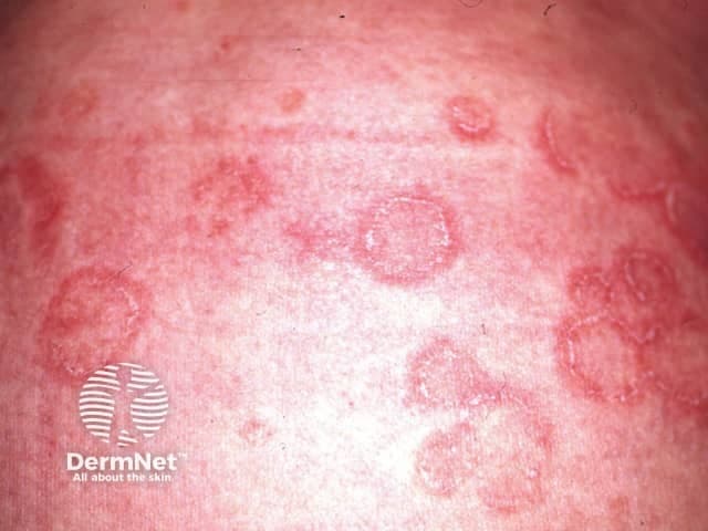 Clinical photography of multiple annular, erythematous plaques on the trunk. The lesions show well-demarcated circular borders with superficial scaling and central clearing, consistent with tinea corporis until proven otherwise. The morphological pattern is ring-shaped (annular) with a slightly raised, erythematous margin and dry scale at the edge. Colors range from pink to brick-red, with varying intensity due to lighting. The trunk is the primary region; symmetrical or scattered lesions may occur, often pruritic. The image illustrates characteristic dermatophyte infection of the cutaneous surface, invading stratum corneum with hyphal elements; differential includes granuloma annulare, nummular eczema, pityriasis rosea, pityriasis circinata, and less likely psoriasis. Clinically significant because early recognition allows topical antifungal therapy (terbinafine, itraconazole) or systemic treatment for extensive disease, and avoids unnecessary biopsy. Suggested confirmatory tests include KOH preparation showing hyaline fungal elements or fungal culture. This photo is suitable for medical education, dermatology training, and dermatopathology correlation; it supports telemedicine triage and patient counseling. Annotated features include annular lesion morphology, active border, central clearing, peripheral scale, and trunk localization. Visual cues such as peripheral scale and erythematous edge aid rapid presumptive diagnosis, while correlation with symptoms (itching) and exposure history supports management decisions and prognosis for educational purposes.