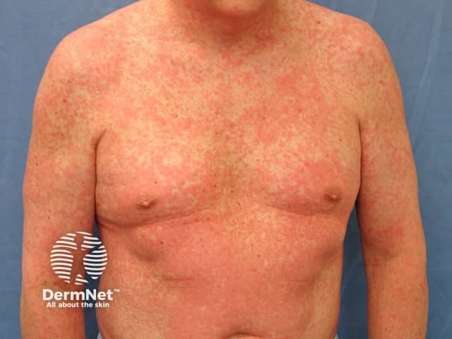Clinical photography of an adult male presenting with a diffuse morbilliform eruption involving the trunk, shoulders, and proximal upper limbs. The image, obtained in frontal/anterior view under standard white‑light illumination, shows numerous erythematous macules and papules that are closely spaced and blanch with pressure. The rash is symmetric on the chest, upper abdomen, and the upper arms, with minimal confluent areas on the torso. No vesicles, purpura, or necrosis are evident, and there is no obvious mucosal involvement in the visible portions of the face or oral cavity. The morphology is characteristic of a morbilliform (measles‑like) exanthem, typically arising from either a viral infection or a drug reaction. The color is uniform red, and the lesions appear non-desquamating with intact epidermal surface in this field of view. The patient's age and body habitus are consistent with adults who can develop drug eruptions or viral rashes, though vaccination history and recent medications are critical for interpretation. Clinically, this pattern warrants evaluation for infectious etiologies (measles, rubella, parvovirus B19) and common drug eruptions (antibiotics, anticonvulsants, NSAIDs). Management considerations include symptom control, identification of potential triggers, and monitoring for evolution to fever, systemic involvement, or mucosal lesions. Documentation supports differential diagnosis, and education for patient counseling and follow-up.