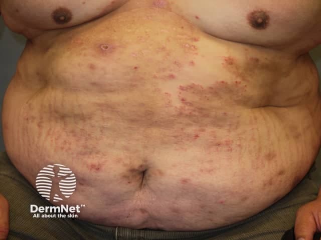 A high-resolution clinical photograph in frontal view of the abdomen and anterior trunk shows widespread, annular, erythematous, scaly plaques with well-defined, active borders and central clearing, classic for tinea corporis (dermatophytosis). The lesions vary in size and appear to coalesce across the midline and lateral abdominal surfaces, with peripheral scaling and mild erythema. Some plaques display lighter centers and darker pruritic borders, and a few areas show subtle vesiculation at advancing margins. No mucosal involvement is evident. The image demonstrates ring-shaped morphology, multiple lesions, and a diffuse trunk distribution that is educational for recognizing extensive cutaneous fungal infection. This depiction supports differential diagnoses including nummular dermatitis, eczema, psoriasis, pityriasis rosea, and granuloma annulare, though the characteristic central clearing and annular configuration strongly favor dermatophyte infection. Clinically, the finding informs management with topical antifungals (azoles or allylamines) and, in extensive disease, systemic therapy such as terbinafine or itraconazole, along with precautions to prevent transmission. The photograph serves as a valuable teaching resource for dermatology, infectious disease, and medical education, illustrating clinical presentation, morphological features, and the importance of correlating with mycological testing when needed. Imaging modality: clinical photography; technique: digital capture; no contrast.