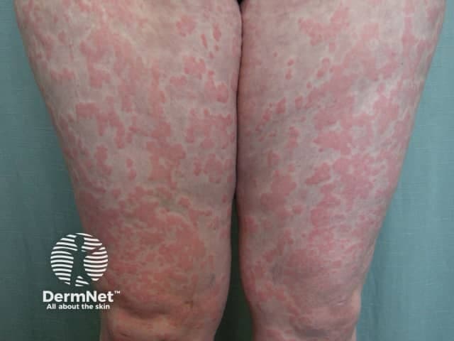 This is a high-resolution clinical photograph of the anterior aspects of both thighs and legs showing widespread erythematous, coalescing patches with fine scaling distributed bilaterally on extensor surfaces and proximal lower limbs. The skin appears dry with diffuse erythema; borders are variably defined and some plaques show mild lichenification. No vesicles or crusts are clearly visible. The pattern is symmetric and patchy, more pronounced on the thighs and distal legs near the knees, with faint residual hyperpigmentation in older lesions. The image suggests a chronic inflammatory dermatosis such as atopic dermatitis (eczema) or contact dermatitis, though psoriasis or fungal infection (tinea) could mimic the appearance. Absence of clear vesiculation or pustulation argues against acute dermatitis. Etiology may relate to irritant or allergen exposure, scratching, or a systemic inflammatory condition. In clinical practice, this pattern would warrant correlation with symptoms (pruritus, swelling), exposure history, and potential skin biopsy if diagnostic uncertainty persists. This image is valuable for education on diffuse eczematous eruptions, differential diagnosis of extensor-surface dermatitis, and assessment of therapeutic response to topical corticosteroids, emollients, or phototherapy. Relevant search terms: dermatitis, eczema, atopic dermatitis, contact dermatitis, psoriasis, tinea, dermatology, lower extremity rash, bilateral leg lesions, chronic skin disease. for reference.
