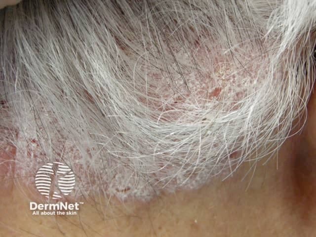 A high-resolution clinical photograph of the scalp shows classic plaque psoriasis with prominent silvery scales and erythematous, well‑demarcated plaques involving the hair-bearing scalp. The image demonstrates diffuse to patchy involvement, concentrated along the frontal and parietal regions with extension toward the occipital area and hairline. Adherent scale covers the plaques, producing a flaky, powdery surface in places and occasional fissuring at the scalp margins. Surrounding skin shows mild erythema without overt pustules, secondary infection, or exudate in this view. The lesion morphology is characteristic of plaque-type psoriasis (psoriasis vulgaris) rather than seborrheic dermatitis or tinea capitis, which may show more greasy scales or alopecia, respectively. This image is valuable for clinical education and research on psoriasis comorbidity with smoking: tobacco use is associated with increased disease severity, earlier onset, and poorer therapeutic response; smoking cessation can improve disease control. Therapeutic implications include topical regimens (shampoos with salicylic acid, coal tar, or corticosteroids) and systemic options for extensive disease in smokers. The photograph is suitable for dermatology training, patient counseling, and studies on lifestyle factors influencing psoriasis expression and management. It also illustrates differential considerations with seborrheic dermatitis, lichen simplex chronicus, and fungal infections in the scalp. Useful for exam questions.