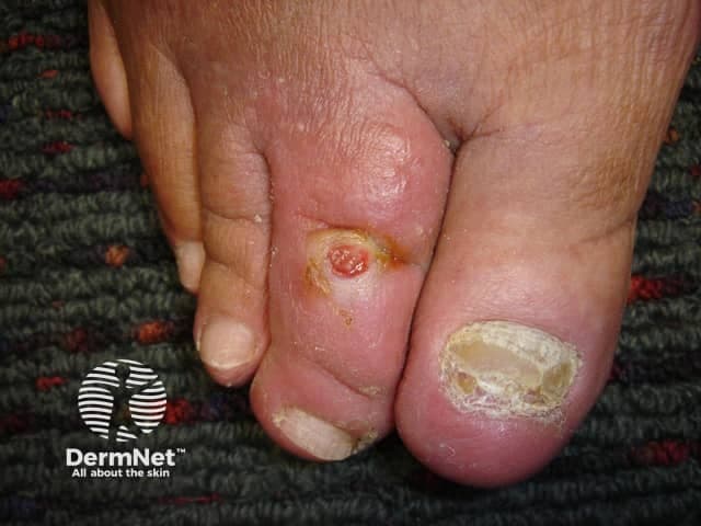This is a high-resolution clinical photograph of a diabetic foot ulcer located on the toe, captured with visible light in a close-up dorsal view. The lesion appears on the dorsal aspect of the toe with a circular to oval ulcer base, demonstrating a pink to red granulation core surrounded by a yellow crust and a thick hyperkeratotic rim. The surrounding skin shows diffuse edema and callus formation, consistent with chronic pressure and neuropathic changes seen in diabetes mellitus. The nail plate is absent or dystrophic at the affected digit. The wound margins are defined but may show shallow undermining, with surrounding erythema indicating localized inflammation. No visible purulence is evident, but slough or crust may obscure depth. This presentation is characteristic of diabetic foot ulcers, which arise from neuropathy reducing protective sensation and repetitive trauma, often in combination with peripheral vascular disease. Clinically, such ulcers require offloading, meticulous wound cleaning and debridement, infection surveillance, glycemic control, and evaluation for osteomyelitis in deeper involvement. Imaging and lab correlation may include vascular assessment, Doppler studies, wound swab cultures, and CBC. The image serves educational purposes in dermatology, podiatry, and wound care training, illustrating management principles for DFU staging, local wound care, and prevention of complications.