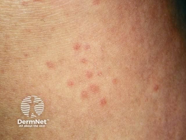 Clinical photography of a patient with cholinergic urticaria showing multiple small, erythematous, blanching wheals on the forearm. Imaging modality is clinical photography; technique involves a high-resolution, color-balanced image capturing superficial skin lesions in a macro-clinical view. The wheals are transient, pruritic, and vary in size from a few millimeters to up to several millimeters, with well-demarcated borders and pale centers. Triggered by heat, exercise, and emotional stress, the lesions can appear soon after sweating and typically resolve within minutes to hours. This presentation correlates with cholinergic urticaria, a physical urticaria subtype linked to cholinergic stimuli, requiring history of triggers and symptom timing. Differential diagnoses include other urticarias and heat-induced dermatoses; diagnostic significance lies in distinguishing exercise/sweat-induced wheals from dermatographism or drug reactions to guide management. Clinical utility includes educating patients on trigger mitigation, optimizing antihistamine therapy, and evaluating for underlying mast cell disorders if atypical features arise. Chronic management includes non-sedating H1 antihistamines at standard or increased dosing, with occasional H2 blockade. Patients are advised to avoid overheating, wear breathable clothing, and perform graded exercise; epinephrine is reserved for rare anaphylaxis. In ambiguous cases, exercise-provoked challenges or sweat tests may help; history differentiates from other physical urticarias.