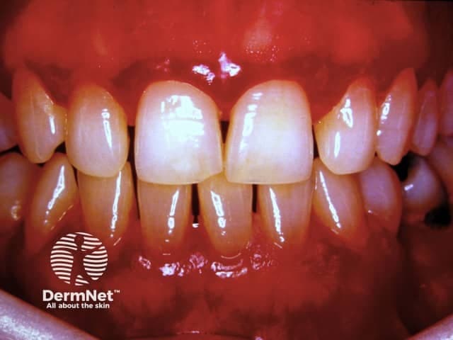Imaging modality: Intraoral clinical photograph (frontal view) of the maxillary and mandibular anterior segments. Anatomical context: oral cavity, specifically the gingival mucosa around the incisors and canines in both arches. Visual features: generalized gingival hyperplasia with bulky, lobulated, fibrous-appearing tissue overlying the crowns of the central and lateral incisors; margins are relatively rounded with mild generalized erythema and slight edema; interdental papillae appear swollen; margin-to-tooth relationship is largely preserved despite enlargement; no radiographic bone detail. The photo shows a reddish-pink gingival color, indicative of inflammation; surface is smooth, with some subtle gloss from lighting. Clinical interpretation: this appearance is characteristic of gingival hyperplasia, which can be plaque-induced, drug-induced (phenytoin, cyclosporine, calcium channel blockers), or hereditary gingival fibromatosis. Not a routine normal variation. Diagnostic significance: highlights need for periodontal evaluation, plaque control, and medical history review; may require gingivoplasty/gingivectomy for functional and aesthetic improvement if fibrous component dominates. Differential considerations include inflammatory gingivitis, drug-related overgrowth, hereditary fibromatosis. Clinical correlation: assess oral hygiene, medication exposure, and systemic conditions; management includes dental cleaning, antimicrobial rinses, periodontal therapy, and potential collaboration with the prescribing clinician to modify contributing medications. This image supports dental education, periodontal training, and case-based learning in gingival enlargement.