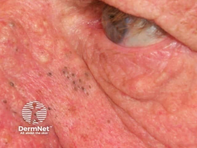 Clinical photography of left periorbital-cheek skin showing solar comedones in actinically damaged facial skin. High-resolution color digital close-up reveals numerous small, dilated follicular openings filled with keratin plugs (open comedones) appearing as black‑brown puncta. Surrounding skin is coarse and parchment-like with flat to slightly raised yellowish areas of elastosis; there are fine telangiectasias and minimal inflammatory erythema. The distribution is characteristic of sun‑exposed facial regions, particularly the malar and periorbital zones; severity suggests Favre-Racouchot syndrome when combined with deep solar elastosis. Visual features include multiple discrete comedones, some coalescing, with minimal surrounding pustulation. The image conveys actinic damage and premature photoaging. Diagnostic significance lies in distinguishing solar comedones from acne vulgaris and other open comedones; clinicians should correlate with patient age, outdoor exposure, smoking history, and ocular surface signs. Differential considerations include acneiform open comedones and Favre-Racouchot syndrome; keratoacanthoma is unlikely in this sun-damaged distribution. Management implications involve sun protection, topical retinoids to promote follicular turnover, comedone extraction, and, in extensive disease, systemic therapy such as isotretinoin. This image is valuable for dermatology education, photodamage assessment, and teaching the appearance of actinic damage-related follicular plugging. Note features include preserved eyelid margin integrity with underlying sun damage; image supports teaching patient counseling on sun avoidance, sunscreen efficacy, and early lesion recognition to prevent progression.