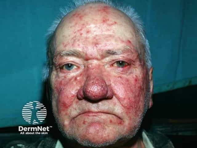 Comprehensive Description: This clinical photograph shows an elderly male with an advanced rosacea phenotype, dominated by severe papulopustular eruption and rhinophyma. Modality is digital clinical photography in visible light, frontal/anterior view of the face. Anatomical localization centers on centrofacial skin, with marked nasal bulbar hypertrophy and thickened, irregular nasal skin; accompanying erythema and telangiectasia extend to the cheeks, forehead, and perioral regions. Visual features include diffuse intense erythema, coalescing papules and pustules, nodules, and edema of the nasal pyramid; the nose exhibits notable rhinophymatous remodeling with bulbous contour and sebaceous prominence. There is no evident ocular involvement in this image. The pattern is pathognomonic for rosacea with rhinophyma change: centrofacial distribution, vascular ectasia, inflammatory acneiform lesions, and smooth-to-nodular nasal thickening. Differential considerations include acne rosacea versus acne vulgaris in older adults, seborrheic dermatitis, granulomatous diseases such as sarcoidosis or lupus pernio, and mucocutaneous infections; however the combination of nasal hypertrophy and facial erythema strongly supports rosacea with rhinophyma. Clinical significance: this stage informs treatment planning, including anti-inflammatory therapies (topical metronidazole, azelaic acid; oral doxycycline), and consideration of surgical rhinophyma reduction (laser therapy, dermabrasion, scalpel/clipping). Use cases: dermatology education, case repositories, teledermatology review, and research on rosacea progression for clinician education.